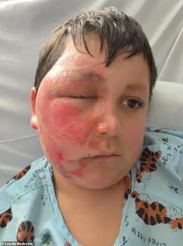 14-Year-Old Girl Hospitalized with Severe Burns After Attempting Viral Fire-Breathing Challenge on TikTok, Officials Warn
