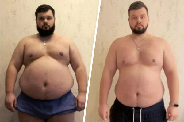 Ukrainian Man with Obesity and Heart Conditions Forcibly Mobilized Despite Medical Exemptions