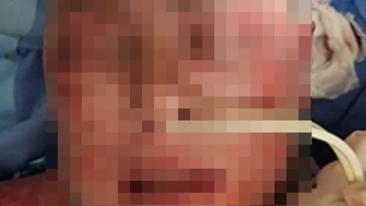 Brazilian Woman's Face and Body Blisters from Mental Health Drug Reaction