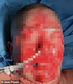 Brazilian Woman's Face and Body Blisters from Mental Health Drug Reaction