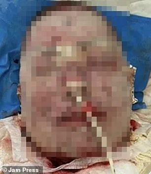 Brazilian Woman's Face and Body Blisters from Mental Health Drug Reaction