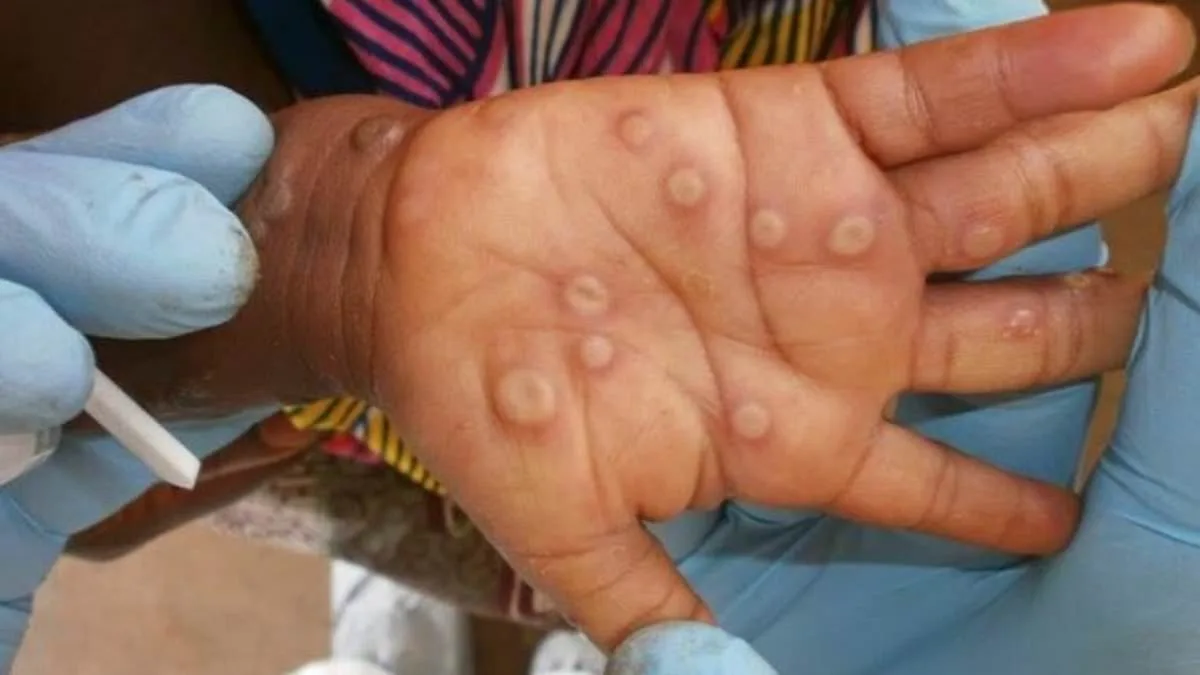 San Francisco Confirms First Case of More Virulent Mpox Clade I