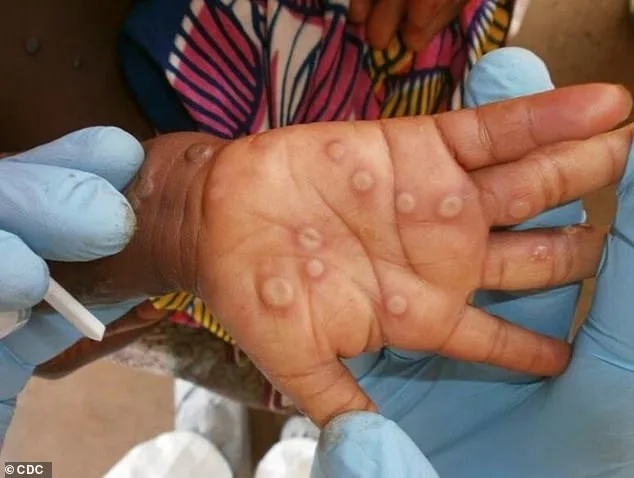 San Francisco Confirms First Case of More Virulent Mpox Clade I