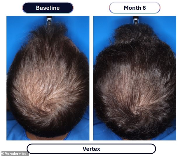 Veradermics' new oral Minoxidil quadruples hair regrowth in pivotal study.