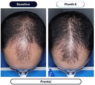 Veradermics' new oral Minoxidil quadruples hair regrowth in pivotal study.