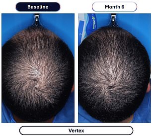 Veradermics' new oral Minoxidil quadruples hair regrowth in pivotal study.