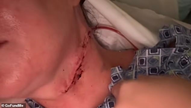 Doctor Dismissed Rachel Passarella's Mouth Lesion Until It Became Exc