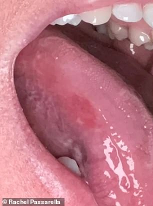 Doctor Dismissed Rachel Passarella's Mouth Lesion Until It Became Exc