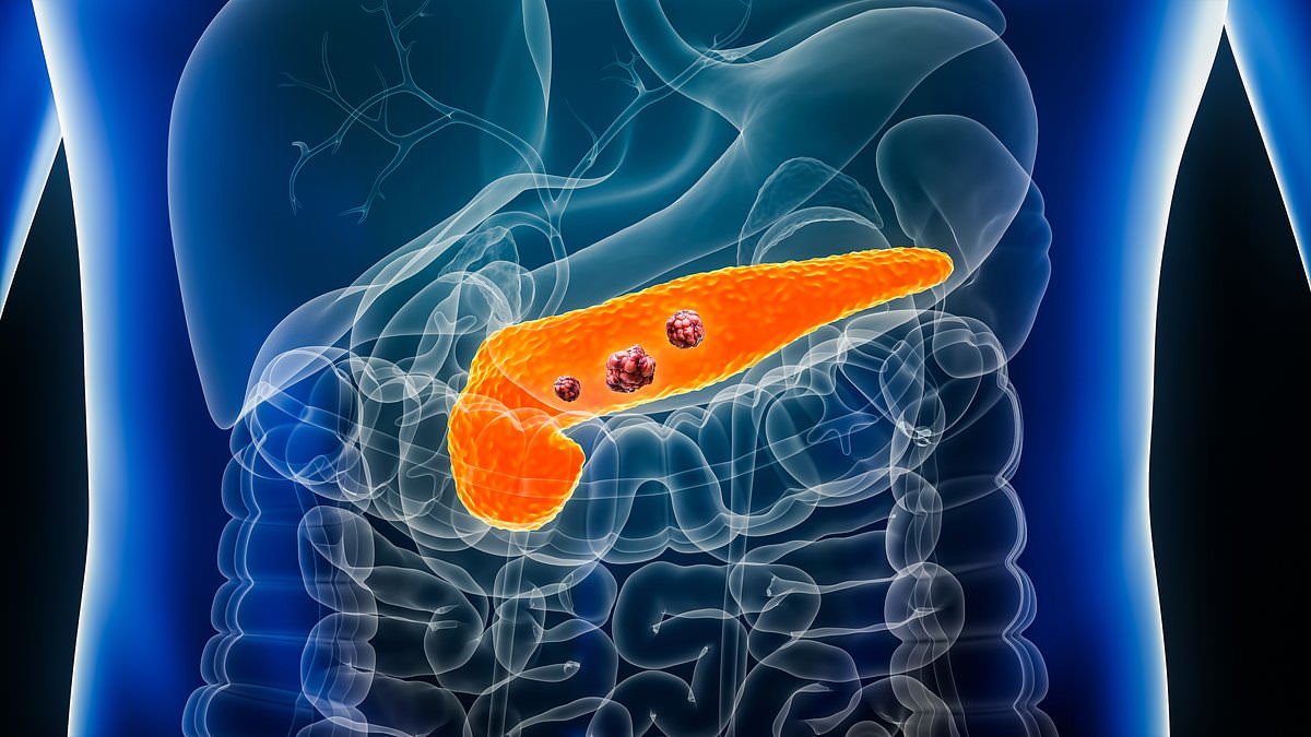 New Blood Test Detects Pancreatic Cancer Earlier Than Current Standard Methods
