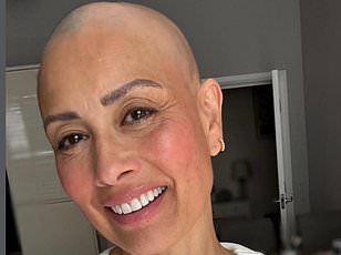 Medical experts warn that early alopecia signs include excess shedding and patchy loss.