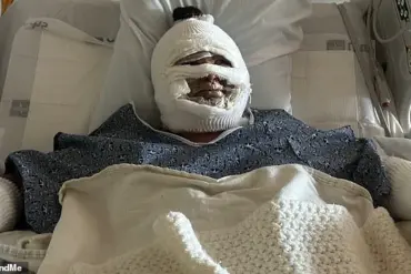 California Woman Suffering Severe Burns After Fire Pit Accident Sparks Safety Discussions