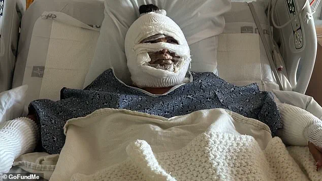 California Woman Suffering Severe Burns After Fire Pit Accident Sparks Safety Discussions